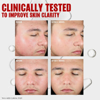 Thayers Blemish Clearing Salicylic Acid Toner, Acne Treatment Face Toner with 2% Salicylic Acid, Soothing and Non-Stripping Skin Care, 12 Fl Oz