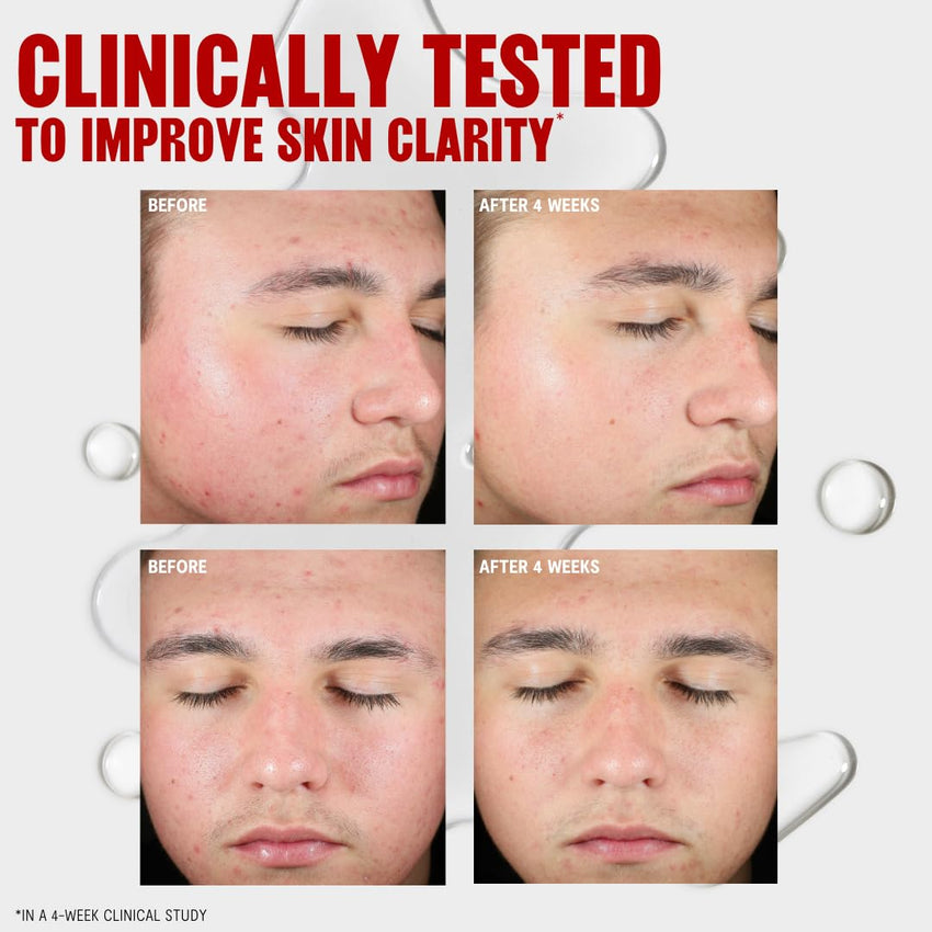 Thayers Blemish Clearing Salicylic Acid Toner, Acne Treatment Face Toner with 2% Salicylic Acid, Soothing and Non-Stripping Skin Care, 12 Fl Oz