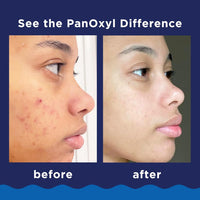 PanOxyl Acne Foaming Wash Benzoyl Peroxide 10% Maximum Strength Antimicrobial, 5.5 Oz - 7DAY'S