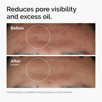 The Ordinary Niacinamide 10% + Zinc 1%, Smoothing Serum for Blemish - Prone Skin - 7DAY'S