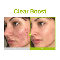 PURITO Azelaic Acid 10% + Kojic Acid + Tea Tree Facial Serum | for Acne & Marks, Breakouts | High-Level Azelaic Acid 10% | Korean skincare, 30mL 1.01 fl.oz