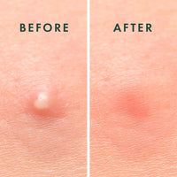 Rael Pimple Patches, Miracle Invisible Spot Cover - Hydrocolloid Acne Pimple Patch, Absorbs Zits & Blemish, Korean Skin Care, 2 Sizes (96 Count)