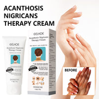 EELHOE Black Acanthoderm Cream Underarm Arm Knee Joint Black Moisturizing Care Cream
