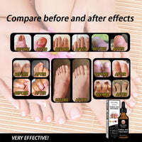 EELHOE Nail Solution Thickening And Brightening Nails Removing Gray Nail Nourishing Nail Care Solution