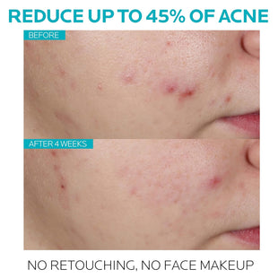 La Roche - Posay Effaclar 1.5% Salicylic Acid Serum, Acne Treatment For Face With Glycolic Acid & Niacinamide, Acne Serum Helps Clear Blackheads, Whiteheads, Pimples & Reduces Post Acne Marks - 7DAY'S