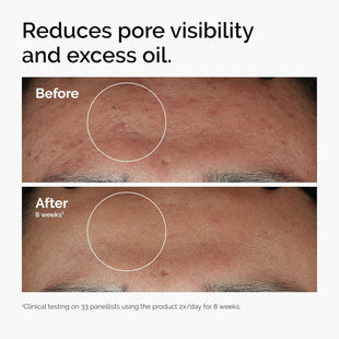 The Ordinary Niacinamide 10% + Zinc 1%, Smoothing Serum for Blemish - Prone Skin - 7DAY'S