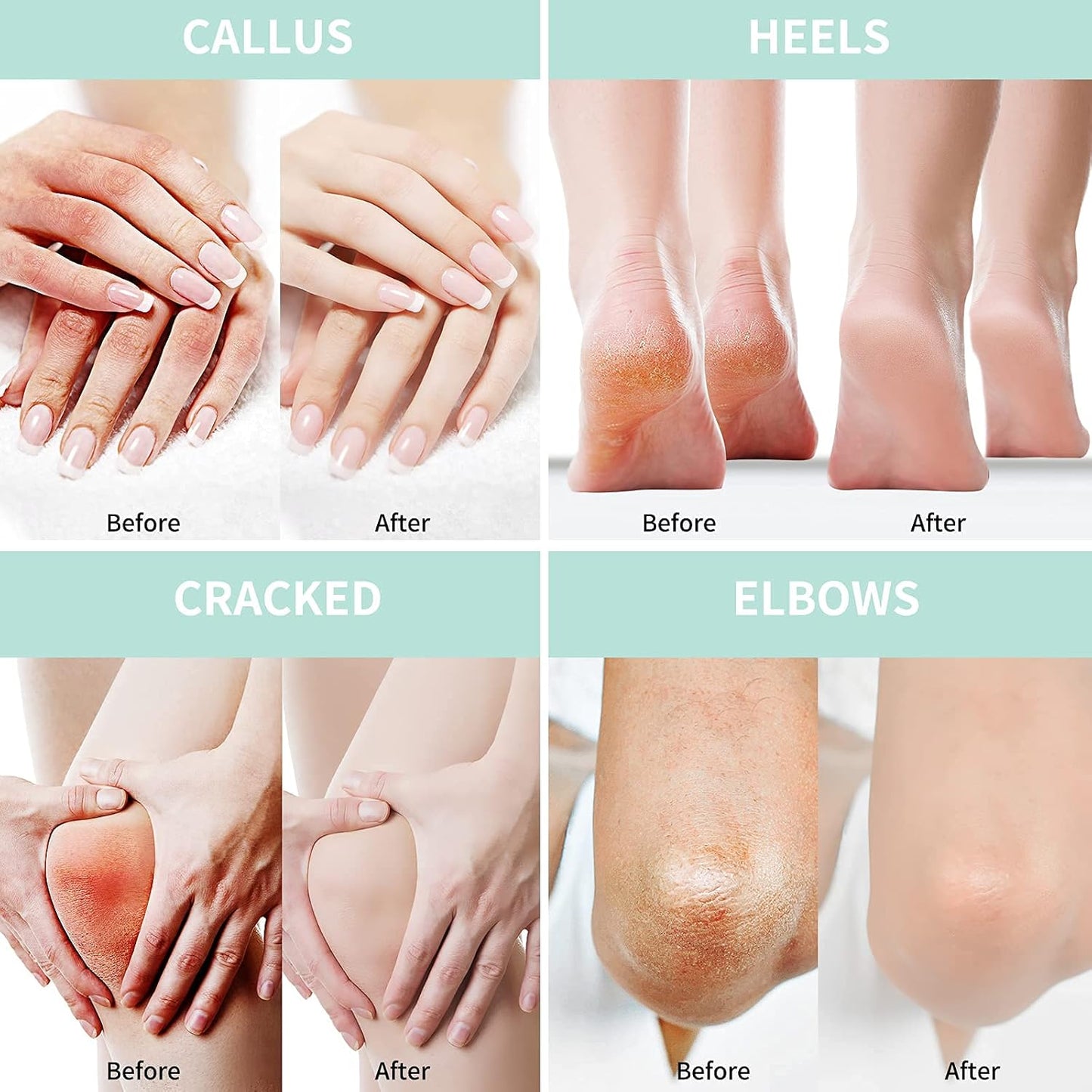 Urea Cream 40 Percent For Feet Plus 2% Salicylic Acid 5.29 oz || Foot Cream and Hand Cream Maximum Strength with Hyaluronic Acid,Tea Tree,and Aloe Vera For Deep Moisturizes,Callus Remover - 7DAY'S