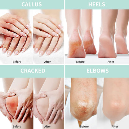 Urea Cream 40 Percent For Feet Plus 2% Salicylic Acid 5.29 oz || Foot Cream and Hand Cream Maximum Strength with Hyaluronic Acid,Tea Tree,and Aloe Vera For Deep Moisturizes,Callus Remover - 7DAY'S